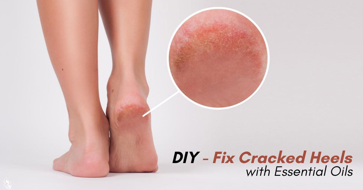 DIY Fix Cracked Heels with Essential Oils