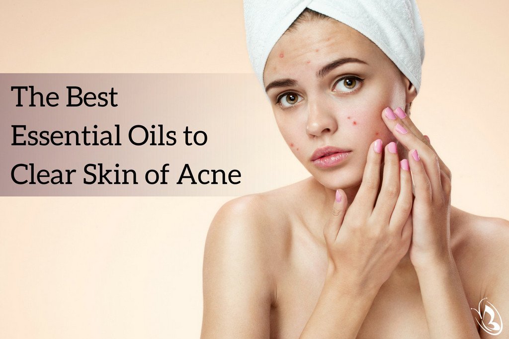 The Best Essential Oils to Help With Acne Organic Aromas®