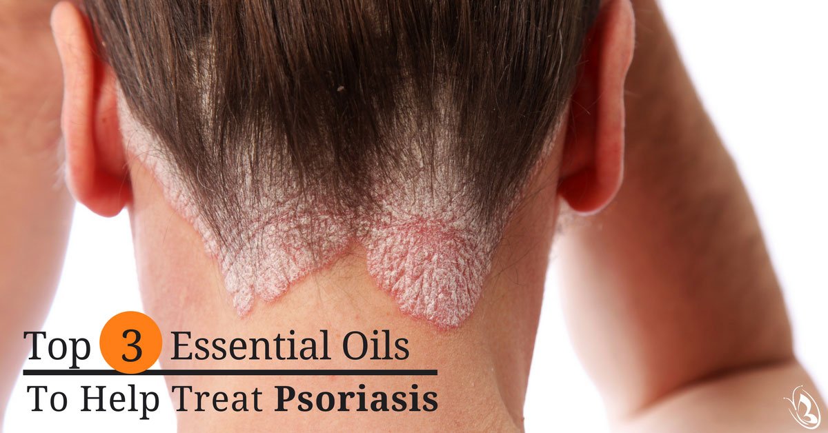 Top 3 Essential Oils to Help Treat Psoriasis