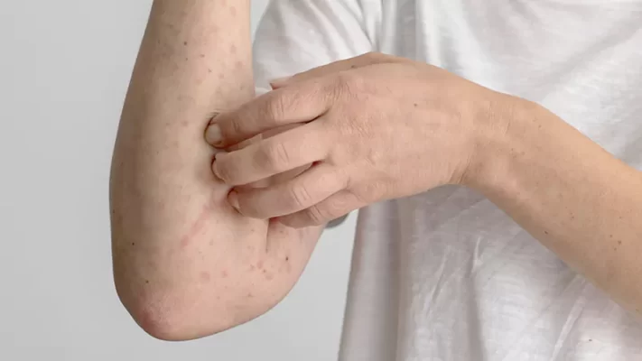 Photo of a man scratching his hand