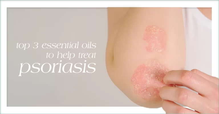 Featured image Top 3 Essential Oils to Help Treat Psoriasis