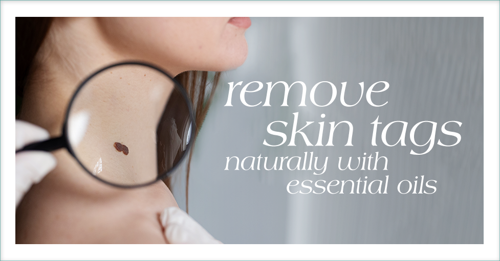 Remove Skin Tags Naturally with Essential Oils featured iamge