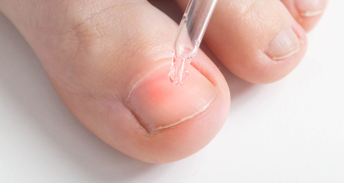 essential oils for toenail fungus