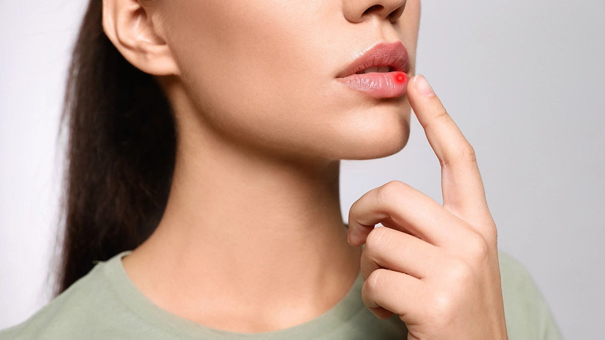 A close-up of a person with a visible canker sore on their lower lip, gently touching it with their finger