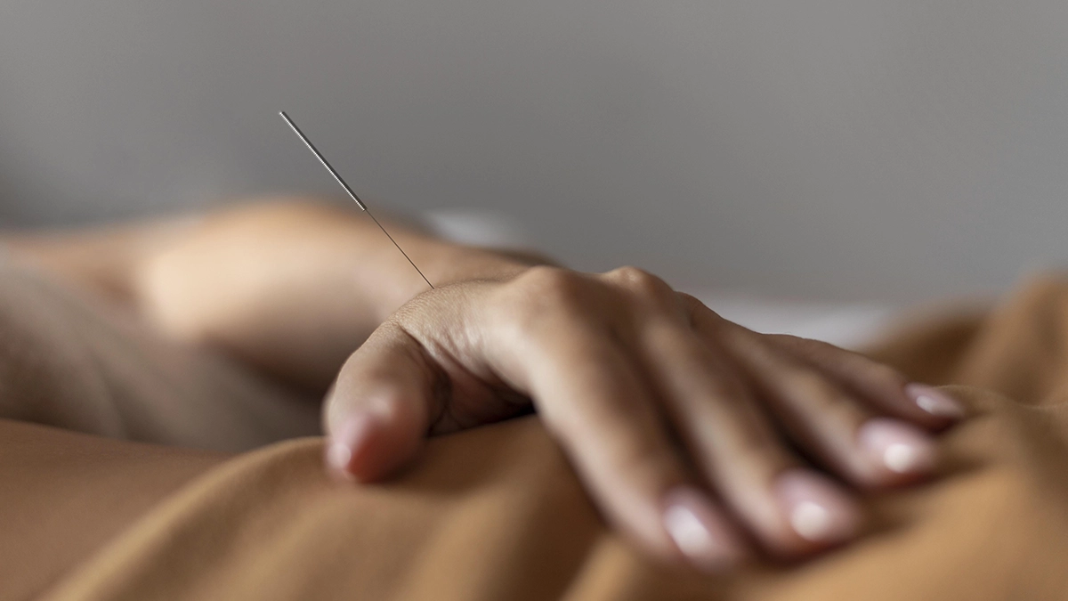 Close-up of a hand with an acupuncture needle, representing complementary holistic treatments