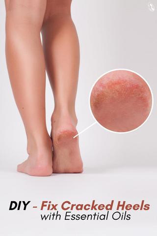 Fix Cracked Heels Overnight Results will Shock You!😳Try it Yourself👌... |  TikTok